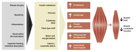근위축 및 근감소 유발요인