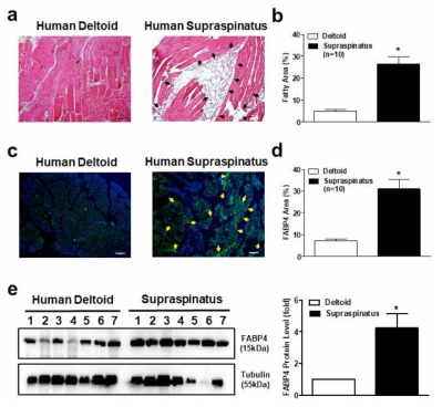 회전근 개 파열 환자의 근육에서 FABP4 발현 (Lee et al, American Journal of Sports Medicine, 2019)