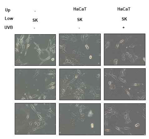 UVB 처리된 각질세포와 공동배양한 흑색종세포
