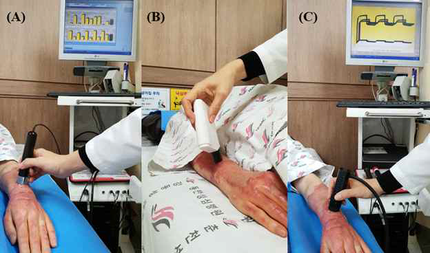 (A) Measurement of melanin levels and erythema using Mexameter® (MX18, Courage-Khazaka Electronics GmbH, Germany), (B) Measurement of sebum using Sebumeter® (Courage-Khazaka Electronic GmbH, Germany), (C) Measurement of elasticity using Cutometer SEM 580® (Courage-Khazaka Electronic GmbH, Cologne, Germany)