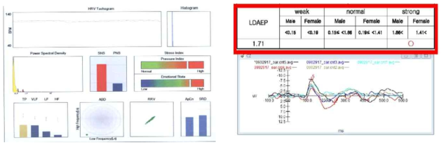 치료 전 autonomic balance test(교감 신경 과항진)와 N100과 P200을 이용한 LDAEP (세로토닌 활성도 감소)