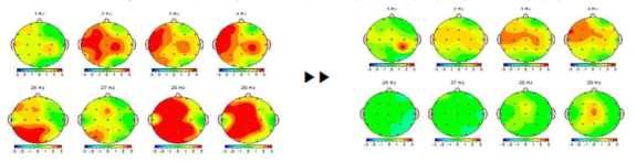 치료 전후 QEEG (치료후 델타파는 물론 긴장과 초조와 관련된 베타파의 파워가 정상화 추세)