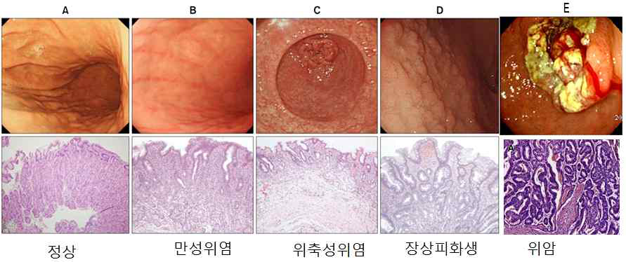 내시경과 병리소견으로 본 위점막의 위암화 진행과정