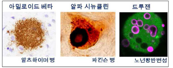 대표적 퇴행성 질환과 각 질환의 특징인 단백질 응집체