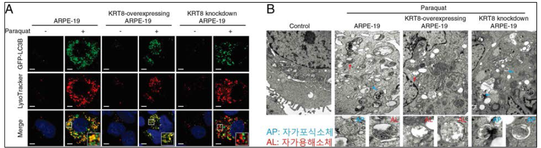 산화스트레스 조건에서 케라틴8 발현량에 따른 망막색소상피세포 내 자가포식작용 관찰. (A) 자가포식소체(녹색 형광)와 리소좀(적색 형광)의 융합 관찰. 케라틴8이 과발현된 세포에서 두 형광의 겹침 정도가 높고, 저발현된 세포에서 두 형광이 거의 겹쳐지지 않음. 케라틴8의 발현량과 비례하여 자가포식소체와 리소좀의 융합이 증가함. (B) 전자현미경을 통하여 자가포식소체와 리소좀의 융합을 통한 자가용해소체 형성 확인. 케라틴8 과발현 세포에서 자가용해소체의 증가가 관찰됨