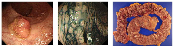 (왼쪽) 내시경 과정 중 발견되는 가족성 용종증 환자의 다발성 용종 사진. (가운데) Indian Ink를 이용하여 용종의 경계를 확인할 수 있음. (오른쪽) 가족성 용종증 환자의 예방적 대장절제를 시행한 사진