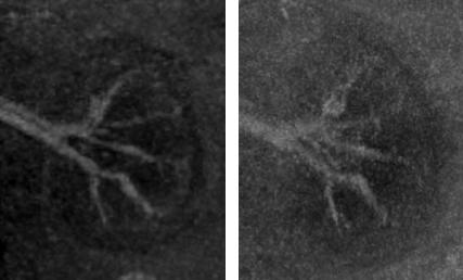 신장의 3nm 조영제의 High resolution 영상(좌측)과 Very high resolution영상(우측) 신혈관을 확인할 수 있음