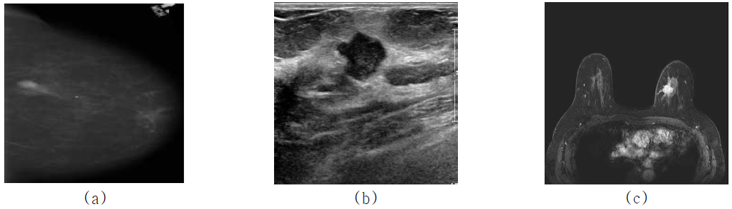 유방 X-선(a), 초음파(b), MR(c) 영상의 예