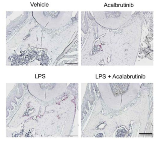 BTK 저해제인 acalabrutinib 의 치조골 보호 및 파골세포 억제 영향