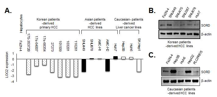 환자 유래 간암세포 구상체에서의 mRNA 발현량(A), 정상간세포주 및 한국인 간암세포주(B), 서양인 간암세포주(C)에 따른 SORD 단백질의 발현량