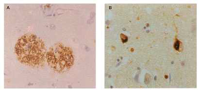 알츠하이머성 치매 환자 뇌의 신경병리학적 특징인 신경반 (A) 신경섬유 덩어리 (B)