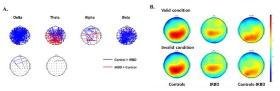 (A) RBD에서 안정 시 뇌파의 기능적 연결성 연구, (B) RBD에서 ERP 연구