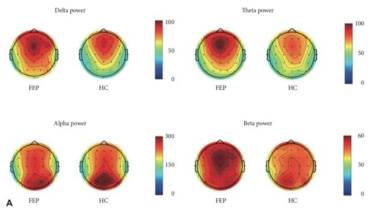 초발 정신증 환자군과 정상 대조군의 휴지기 뇌파의 차이. 전두엽과 후두엽 부위의 델파타에서 두 군의 유의미한 차이가 있었음
