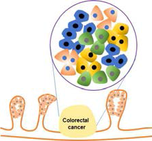 종양내 암세포의 이질성