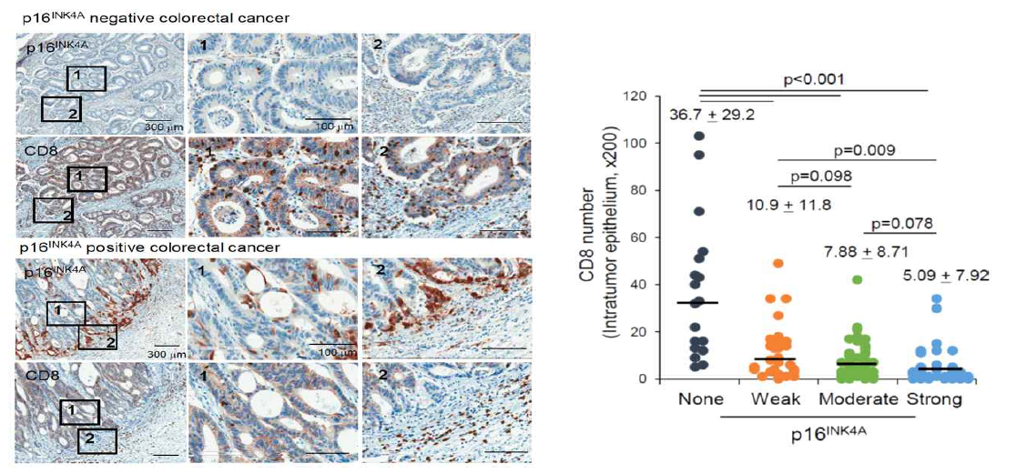 노화 종양세포와 CD8+ T 세포와의 암 조직내 침윤관계