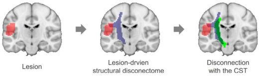 손상 뇌영역에 대한 구조 디스커넥톰 측정 과정. CST, corticospinal tract