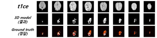 3D MRI 병변 특징 추출