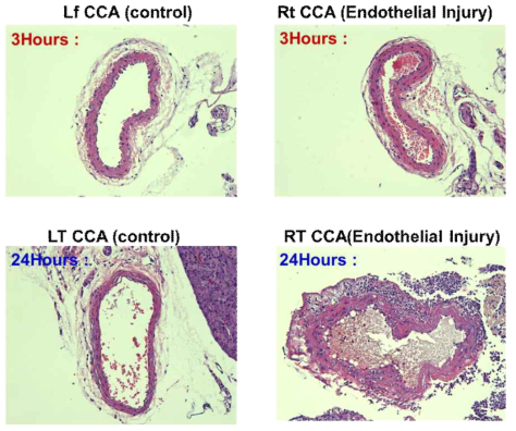 Histological staining of the carotid artery with (right) and without (left) stenosis