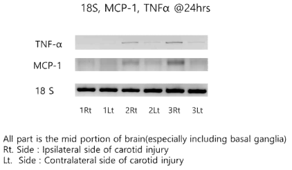 Expression of Inflammation Markers after Right Carotid Artery Injury in Brain