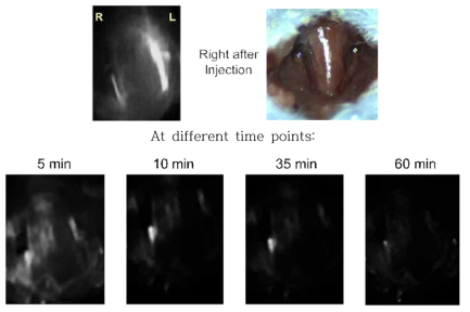 Imaging of carotid stenosis using thrombus targeted bio-imaging agents