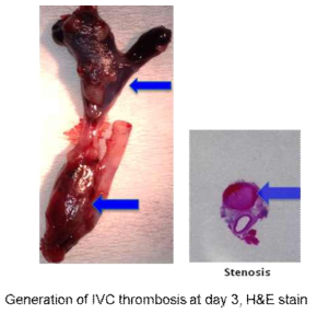 Pathologic specimen of IVC and histologic stain of the IVC after the stenosis