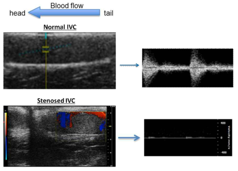 Ultrasound Flow Assessment of IVC Stenosis