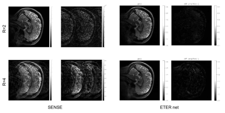 SENSE (좌)와 ETER net (우)로 복원한 영상 및 차분 영상
