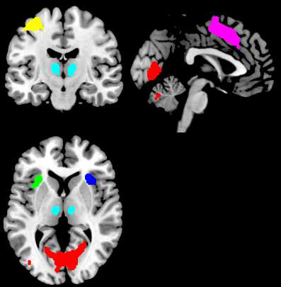 RMET 수행 중 정서인식기능과 관련하여 유의한 활동성을 보이는 뇌 영역