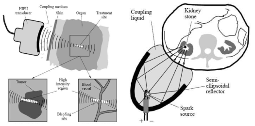(좌) 암 및 (우) 결석을 치료하기 위한 고강도 집속형 초음파 (HIFU) 치료기기의 원리