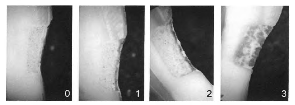 Measuring score of microleakage, no penetration(O), enamel penetration(l), dentin penetration(2), wall penetration(3)