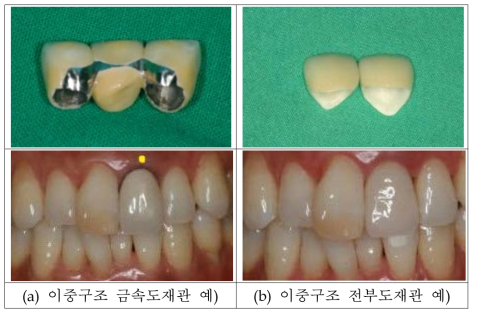 금속 또는 지르코니아를 하부구조로 하는 베니어 세라믹 보철물