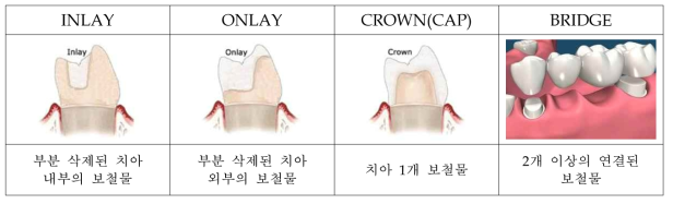 유형별 치과 보철물