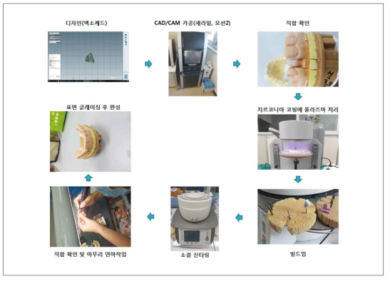 보철물 제작 공정