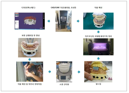 브릿지 보철물 제작 공정