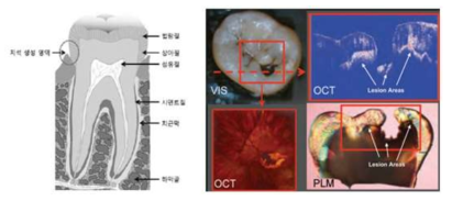 치아의 구성 및 치아 OCT Scanning 화면 예시