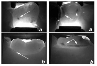 Fiber Optic Transillumination을 통한 우식 검출 예 (출처: A Closer Lookat Diagnosis in Clinical Dental Practice: Part 5. Emerging Technologies for Caries Detection and Diagnosis. J. Can. Dent. Assoc. 2004.)