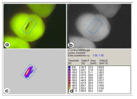 QLF를 이용한 우식 검출 예 (출처: Caries Detetion and Diagnosis: Novel Technologies, J. Dent. 34(10), pp. 727-739)