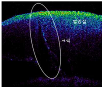 법랑질 내부의 크랙이 보이는 단층영상(샘플3)