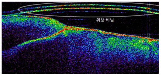 1회용 위생 비닐을 적용한 프로브로 촬영한 치아 영상(샘플5)