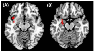 PTSD환자군에서 정상대조군에 비해서 외상관련 사진자극시에 더 활성화되는 뇌 영역. (A) 좌측 편도체 (B) 좌측 섬엽