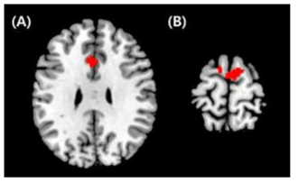 PTSD환자군에서 정상대조군에 비해서 섬엽(insula)와 뇌기능적 연결성이 저하되어 있는 뇌 영역. (A) 전측 대상회(anterior cingulate cortex) (B) 상전두회(superior frontal gyrus)