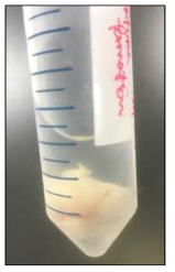 BCD-iPSC derived teratoma