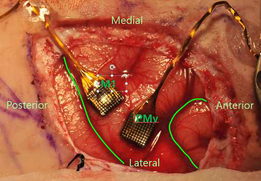 피츠버그 대학에서 제공한 신경 데이터가 수집된 뇌영역. 그림은 전극 삽입 수술 장면