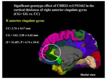 CDH23 유전자 rs11592462 SNP 유전형과 대뇌 피질 두께 간의 상관 관계 (우울증 환자 및 정상 대조군 포함 전체 표본)