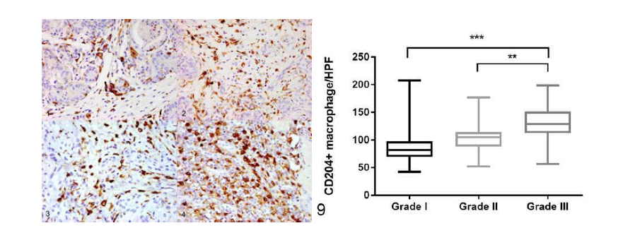 CD204발현 macrophage의 grade별 비교 IHC사진 및 정리 그래프