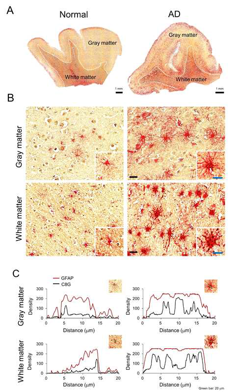 알츠하이머병 환자 뇌조직의 성상교세포 활성과 C8G의 발현 양상