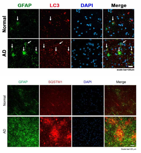 Autophagy markers were elevated in astrocytes of Alzheimer’s patient brain