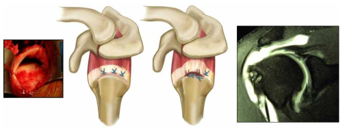 만성 광범위 어깨 힘줄 파열과 어깨 힘줄 봉합술 후 재파열 (좌: 디지털 사진, 우: MRI 사진)