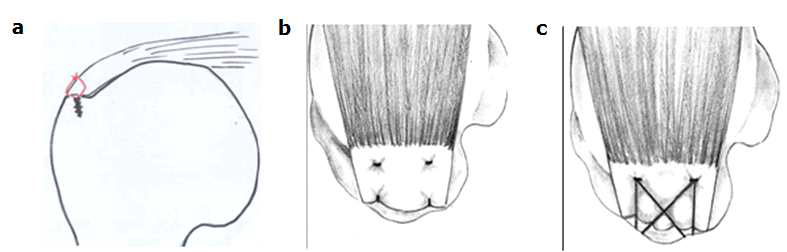 어깨 힘줄 파열 봉합의 대표적 봉합법: (a) 1열 봉합, (b) 2열 봉합, (c) 브릿지 봉합