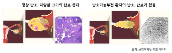 정상 및 난소기능부전 환자의 난소 조직간의 차이